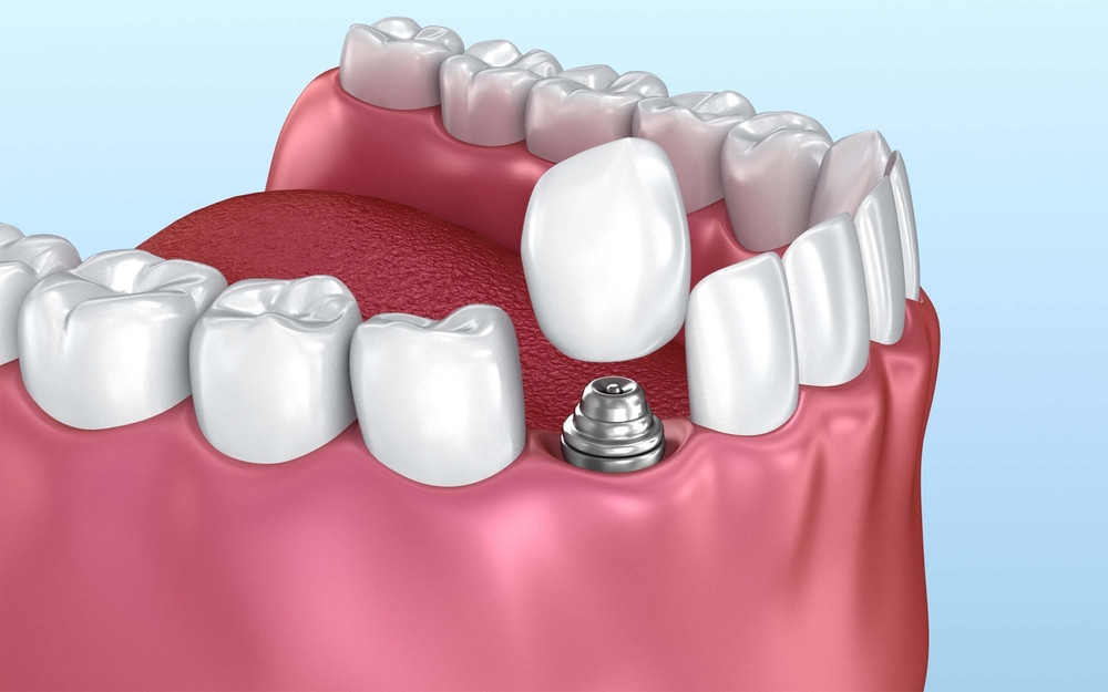 implant dentar bacau, clinica stomatologica life dent bacau, parodontoza bacau