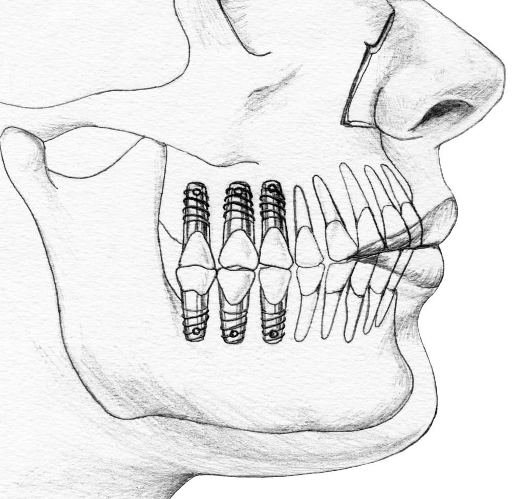 implant dentar bacau, clinica stomatologica life dent implant bacau