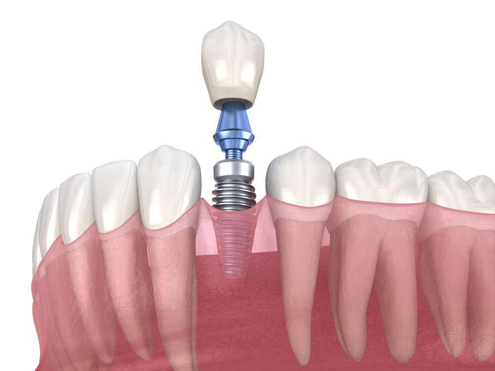 implant dentar Bacău