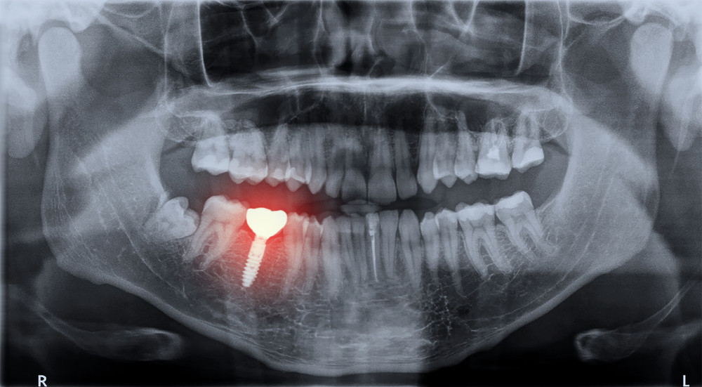 implant dentar bacau, clinica stomatologica bacau Life Dent Implant