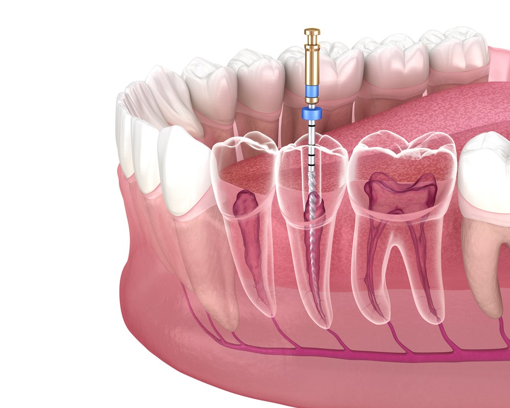 endodontie bacau, clinica stomatologica bacau, clinica LifeDent Implant Bacau