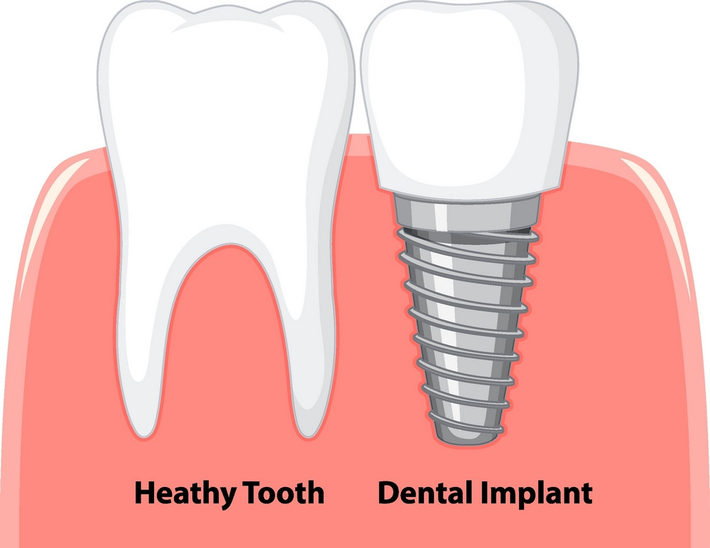 implant dentar bacau, clinica stomatologica life dent implant bacau