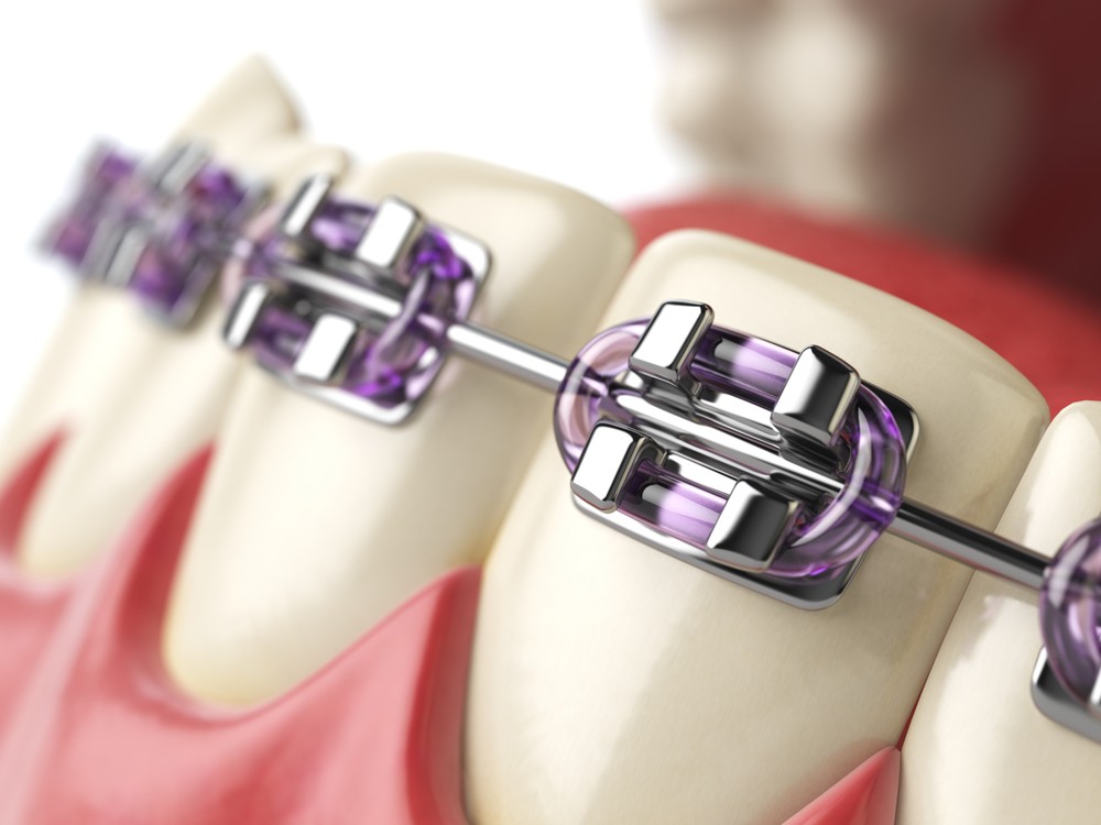 ortodontie bacau, aparat dentar bacau, clinica stomatologica bacau, clinica LifeDent Implant