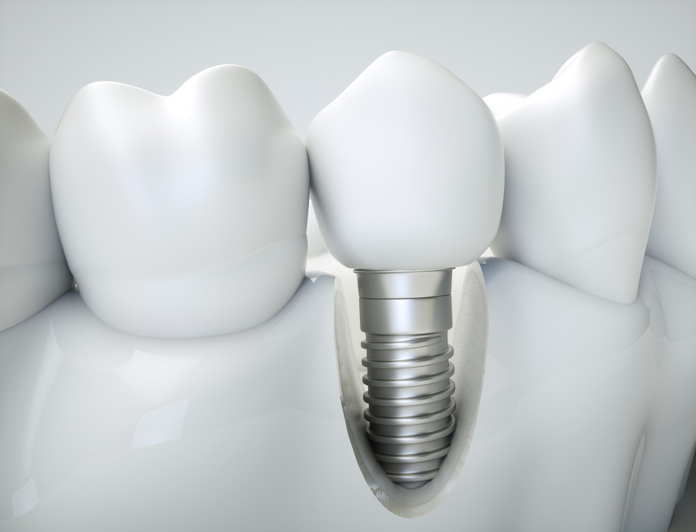 implant dentar bacau, implantologie bacau