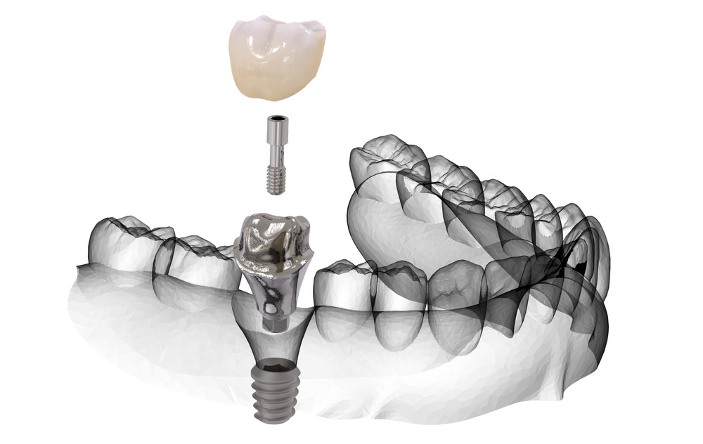 implantologie bacau, implant dentar bacau, clinica stomatologica bacau, clinica LifeDent Implant