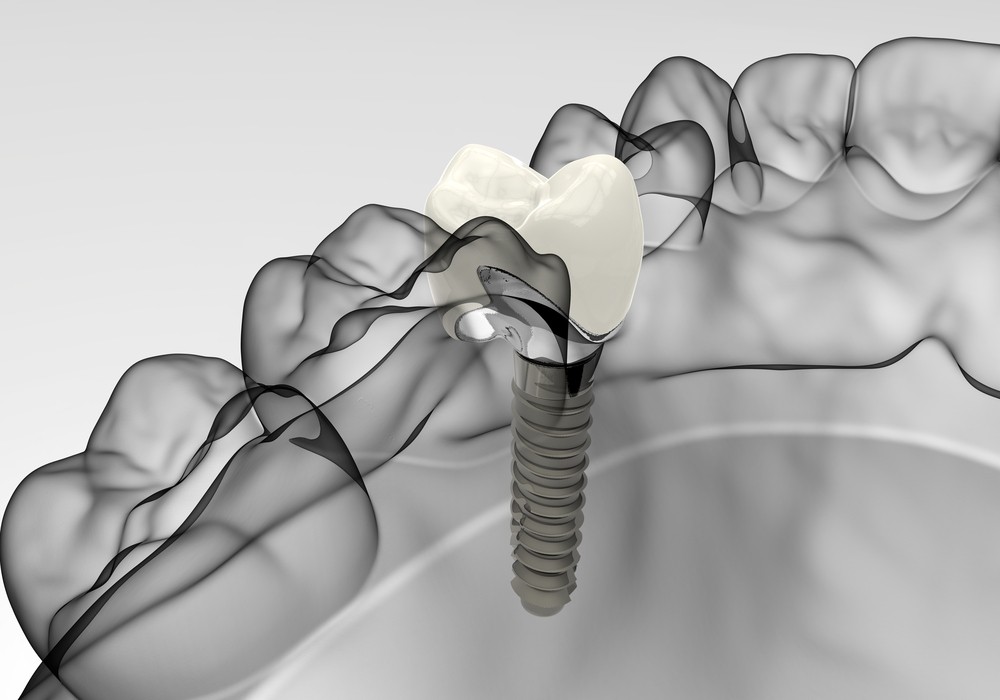 implantologie bacau, implant dentar bacau, clinica stomatologica bacau, clinica LifeDent Implant