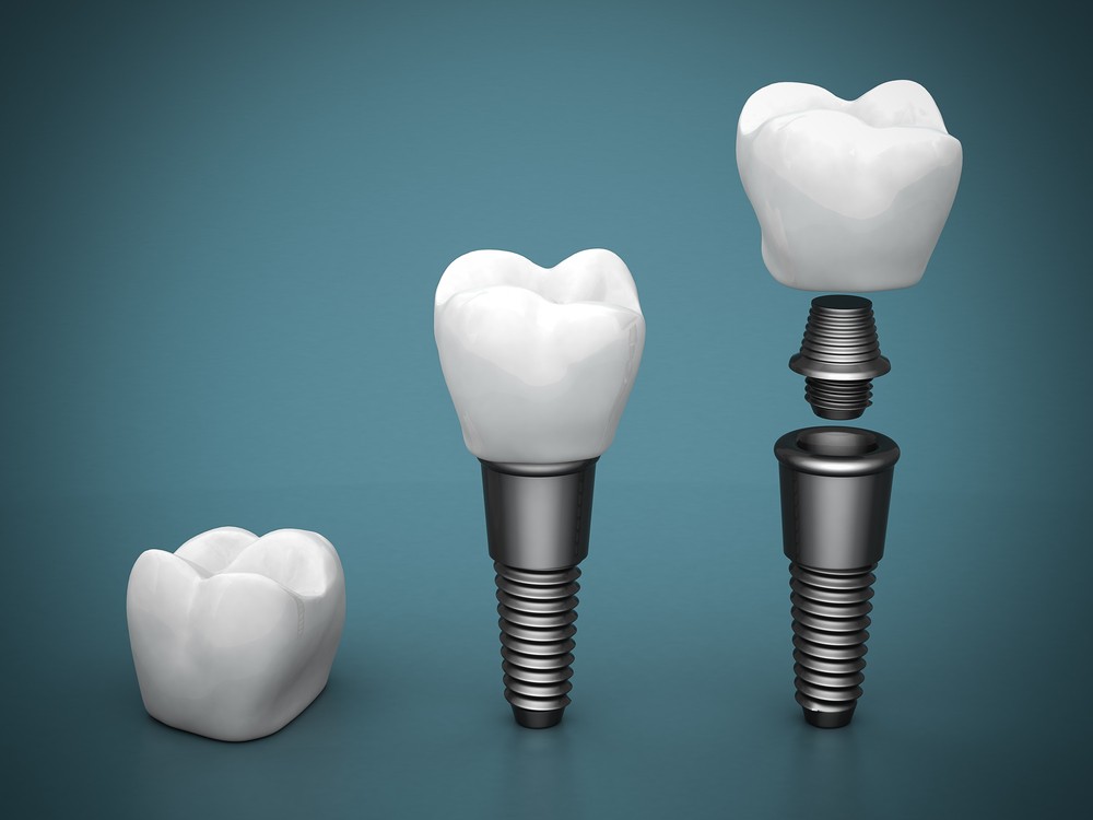 implant dentar bacau, implantologie bacau
